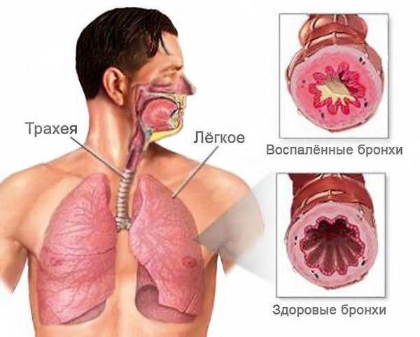 Пневмония – причины, симптомы, диагностика и способы лечения заболевания | Клиника Будь Здоров