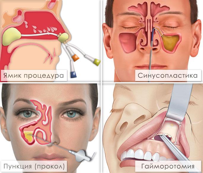 Боль в пазухах носа: причины, диагностика и лечение| Синупрет